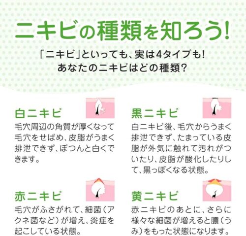 ニキビの種類を解説する図解画像|白ニキビ・黒ニキビ・赤ニキビ・黄ニキビの4タイプを紹介し、それぞれの原因や状態を簡潔に説明したスキンケア初心者向けのイラスト付きニキビ分類ガイド
