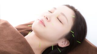 「美容鍼灸を受ける女性の横顔｜顔のリフトアップ・むくみ改善・たるみケアに効果的な美容鍼治療の施術中イメージ」