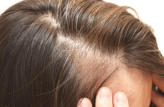 「分け目や生え際の薄毛が進行した女性の頭皮の様子|びまん性脱毛症やAGAの症状例として使用可能なイメージ」